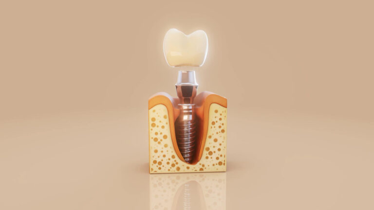 Prototyp implanta zębowego